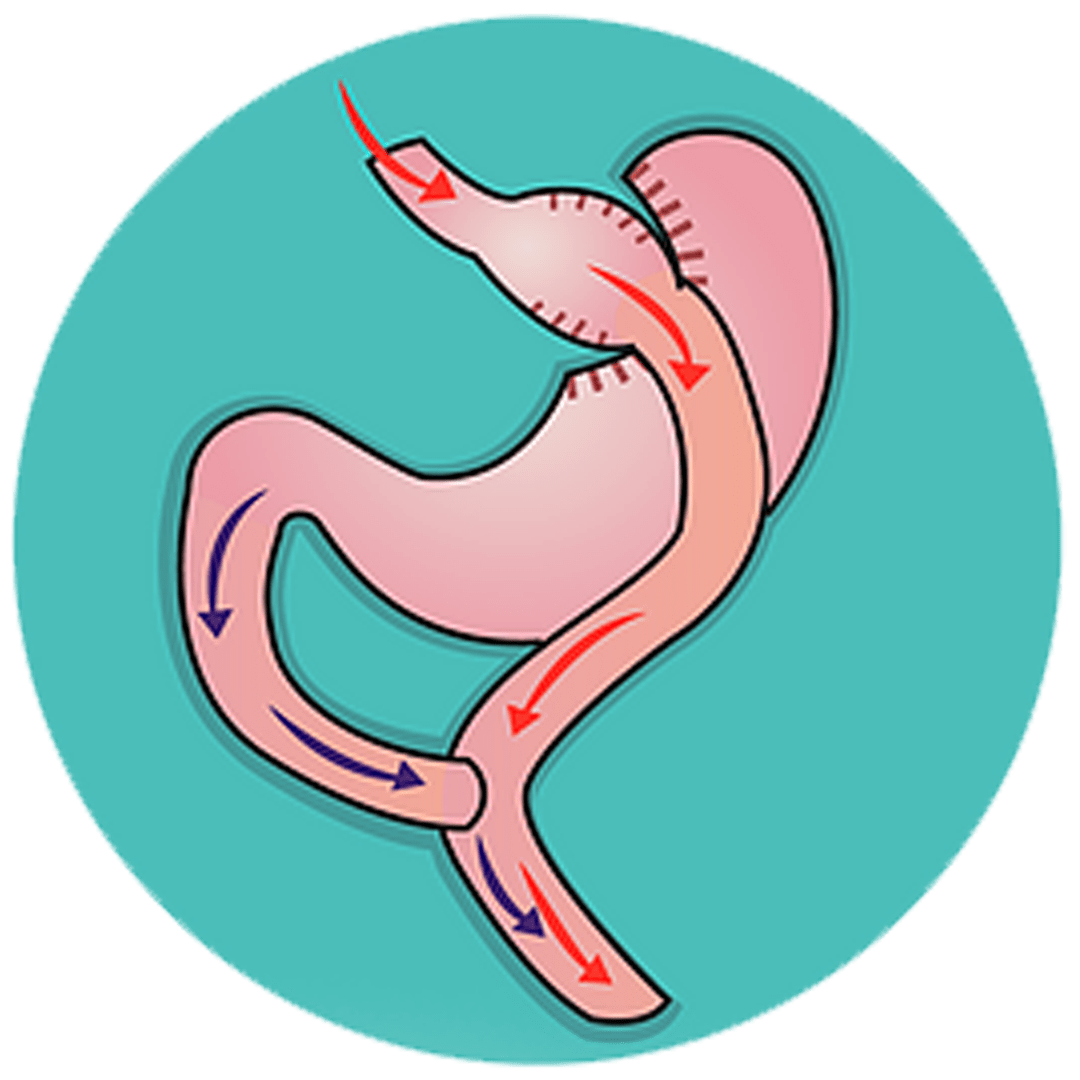 gastric bypass surgery image graphic