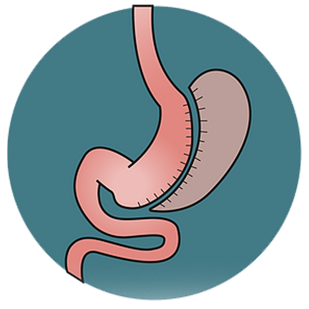 gastric sleeve surgery image graphic